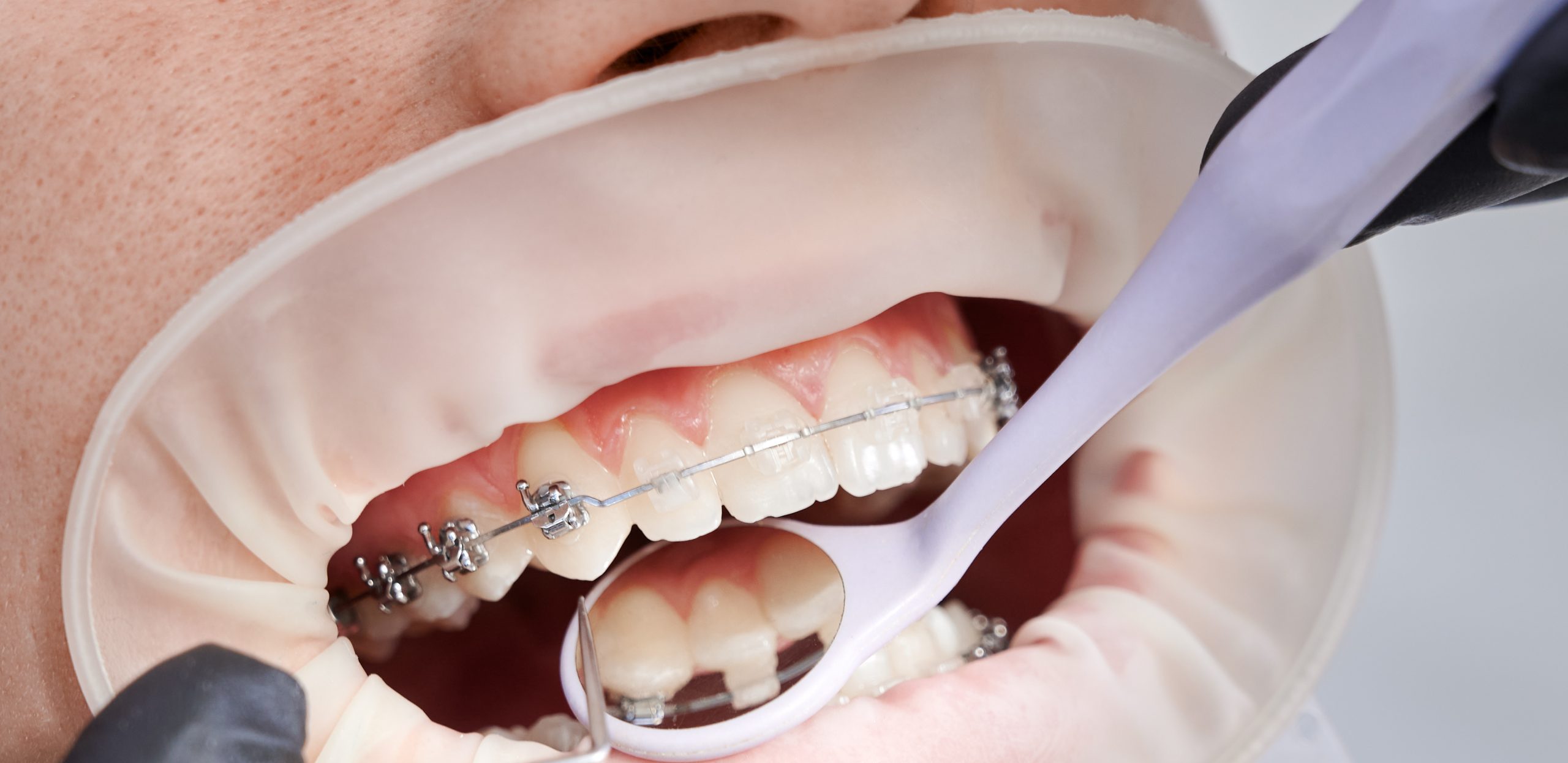 Close up of orthodontist placing orthodontic brackets on patient teeth. Person with cheek retractor and metal braces on teeth having dental procedure in clinic. Concept of orthodontic treatment.